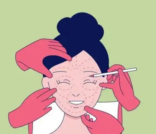 袁强MCR复合提升术和王志坚高位SMAS三平面提升哪个好？3种选择策略解析