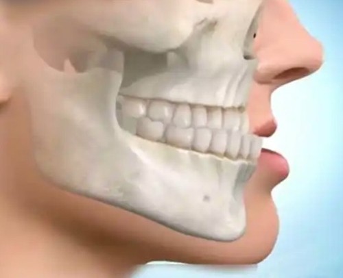 朴正国正颌手术做的怎么样？3D数字化建模技术咬合正常、脸型自然费用不便宜