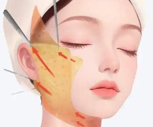 魏广运医生SMAS筋膜拉皮做的好吗？深层复位双矢量力学设计和面具脸说no