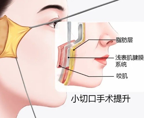 韩国擅长做拉皮的医生是谁？8位口碑拉皮提升名医技术特色与选医指南
