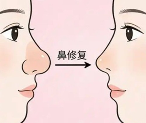 详解隆鼻失败三次还能修复吗？韩国高难度鼻修复医院及医生技术解析