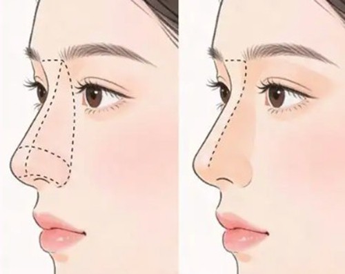 冯思阳肋骨鼻综合做的好吗？OX双氧羽翼鼻骨相化原生美起价35800元