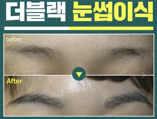 韩国眉毛种植出名的医院布莱克毛发移植中心植眉图片曝光