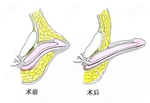 重庆李世荣男性私密手术价格曝光，阴茎延长/增粗技术好可预约