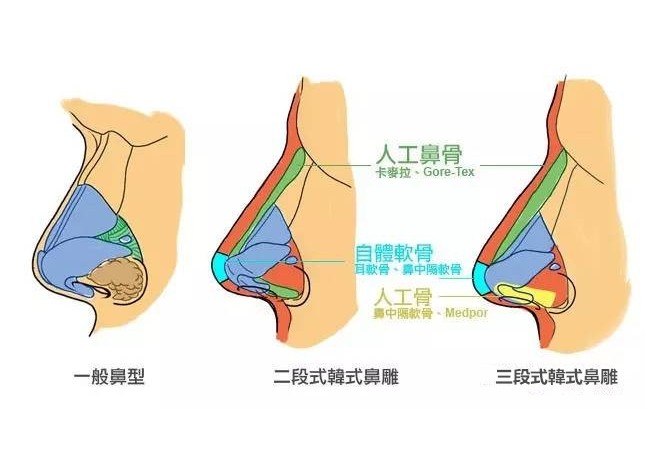 吴玉家在哪家医院？做鼻综合怎么样？费用是多少？