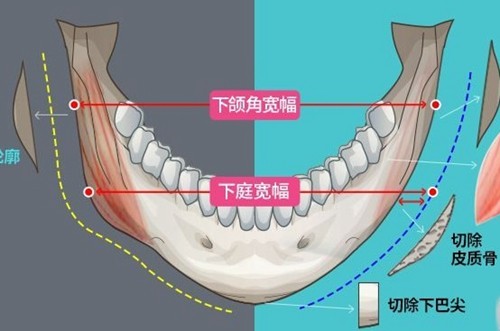 海口磨骨手术多少钱？2025海口下颌角、颧骨整形好的医院价格不贵