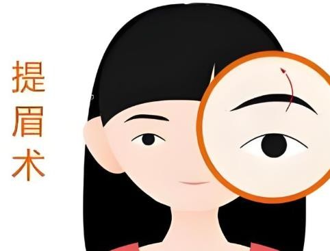 提眉和割双眼皮哪个效果好？手术原理、适用人群、效果对比可参考