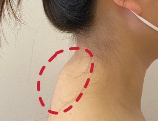 重庆富贵包抽脂多少钱？哪家医院做的好？