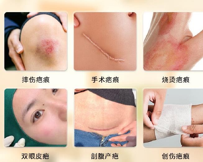 深圳祛疤整形医院哪家好？鹏程、悦尔、鹏爱秀琪等疤痕修复技术好价格透明