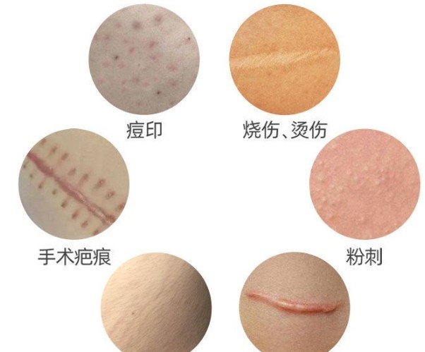 广州疤痕修复正规医院哪家好？一般多少钱？