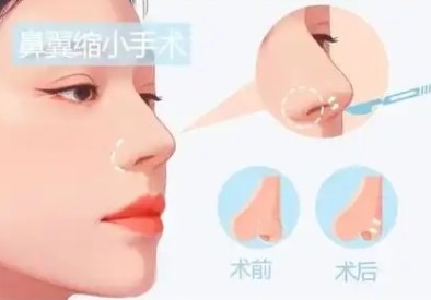 北京缩鼻翼谁做得好？李石/李劲良/刘彦军/巫文云是北京鼻翼缩小好的医生