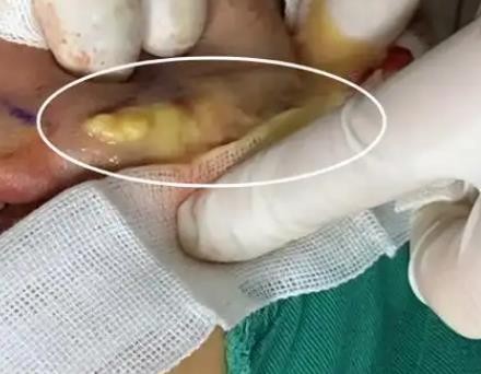 北京异物取出哪个医生好?费用是多少?排名前十的周云超/李奇军胸部奥美定取出干净