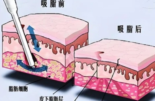 赵军舰医生抽脂收费多少？怎么样预约挂号？