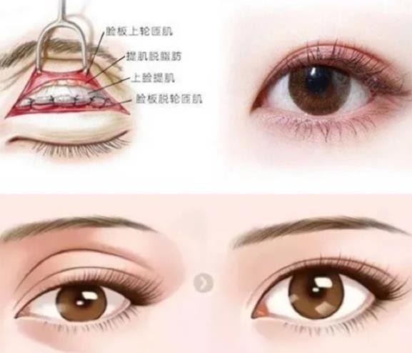 张安利和孔宇修复双眼皮谁厉害？