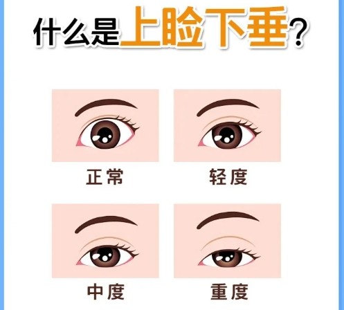 北京美和眼科张丰上睑下垂怎么样？手术费用多少？