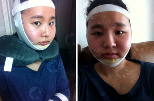 在韩国安菲拉整形医院做面部轮廓第7天