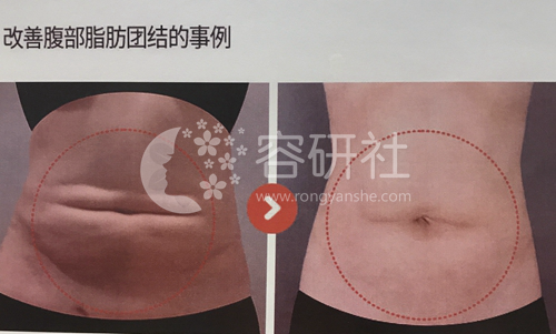 365mc吸脂修复手术改善肚子案例