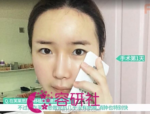 在韩国芙莱思整形医院做完全脸脂肪填充第1天