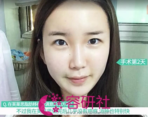 在韩国芙莱思整形医院做完全脸脂肪填充第2天