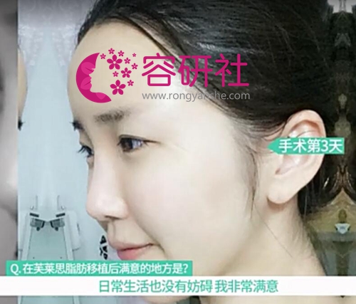 在韩国芙莱思整形医院做完全脸脂肪填充第3天