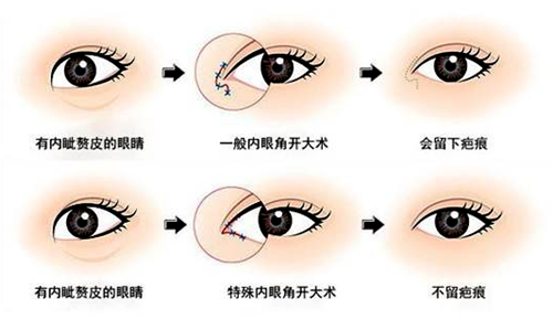 开眼角不同的术式地疤痕的影响
