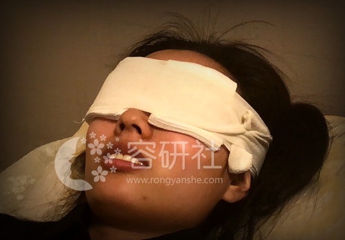 清潭第一成镇模院长双眼皮修复手术后加压包扎24小时