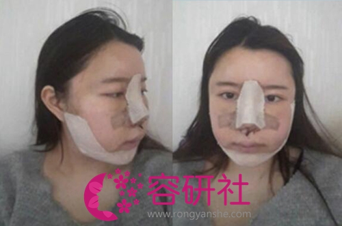 韩国灰姑娘整形医院面部轮廓手术第2天