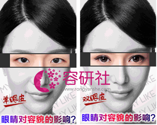 韩国热门整形项目双眼皮手术