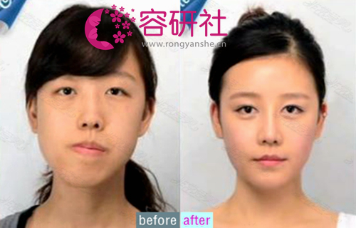 A real case of double jaw surgery at Everm clinic