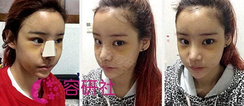 The seventh day after fat graft on overall face at Topface clinic