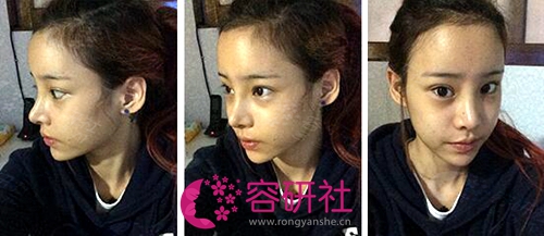 The 14th day after fat graft on overall face at Topface clinic