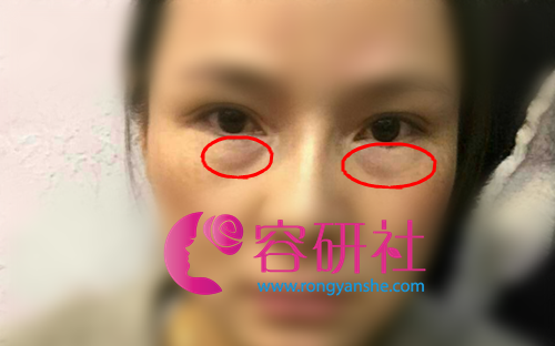 韩国ACE整形外科医院金成雨去眼袋手术前