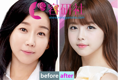 韩国原辰整形外科全脸提升术打造饱满童颜脸