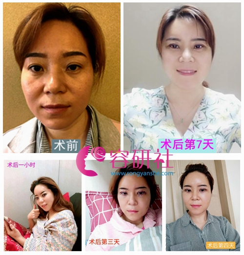 韩国原辰整形外科李尚俸院长自体脂肪填充全脸案例