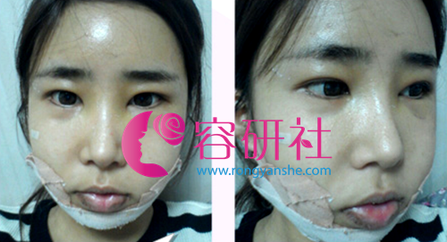 韩国SF整形外科面部轮廓三件套手术第5天