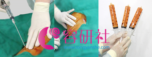 WIZ美整形外科皮肤科美体吸脂针手术过程
