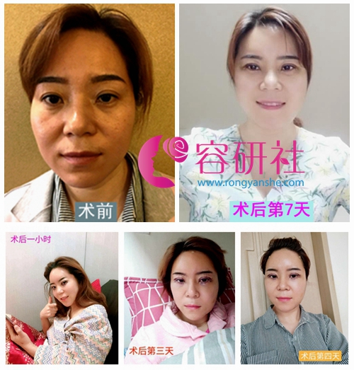 菲德姆术后护理师张娟自体脂肪填充全脸术后1周恢复过程