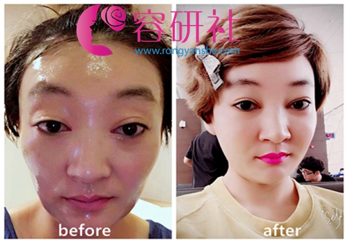 清潭第一城镇模院长双眼皮修复+全脸脂肪填充案例