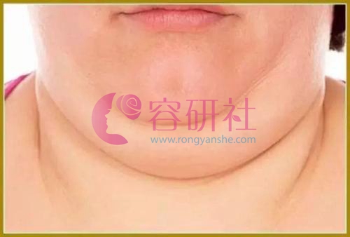 颈部脂肪堆积也会导致颈纹加深