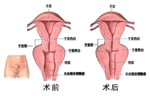 韩国好手艺私密整形医院尹虎珠院长后方膣圆盖术缩阴效果对比