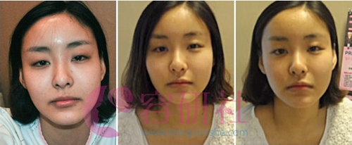 韩国灰姑娘整形医院电眼整形手术前