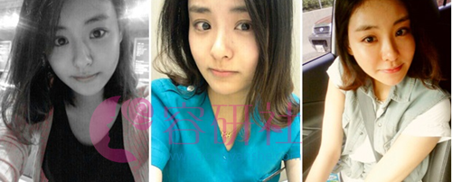 韩国灰姑娘电眼整形术后两个月