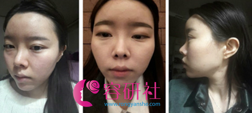 韩国灰姑娘整形医院鼻修复+轮廓手术前
