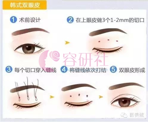 韩国双眼皮手术原理