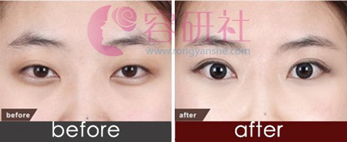 全切双眼皮手术术后前后效果对比
