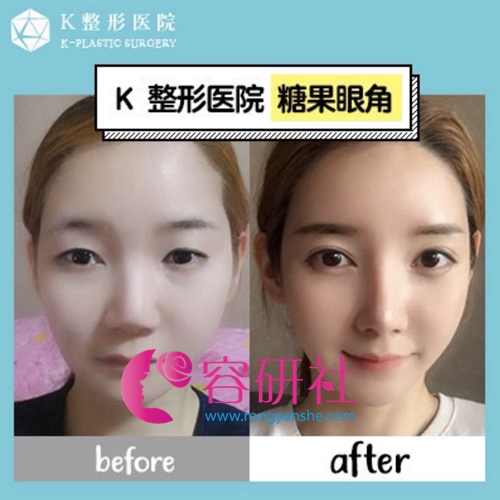 韩国k整形医院糖果眼角手术术前术后对比