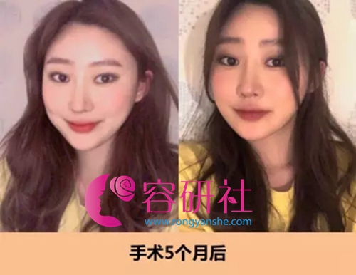 韩国id整形医院面部轮廓+鼻综合手术后5个月