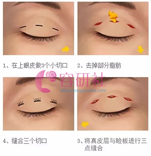 韩式三点双眼皮手术方式