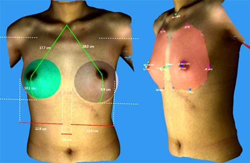 李圣郁自体脂肪隆胸3D幻想机器精准扫描