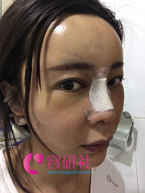 韩国碧夏整形医院额头自体脂肪填充+肋软骨隆鼻手术后第2天